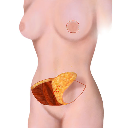 Breast reconstruction with abdominal tissue flap